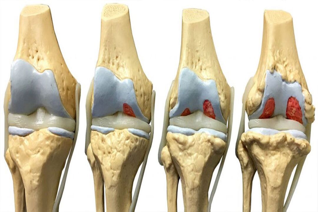 Az arthrosis kialakulásának szakaszai