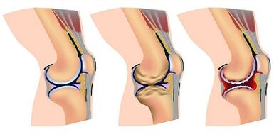 A térdízület arthrosis fejlődésének szakaszai