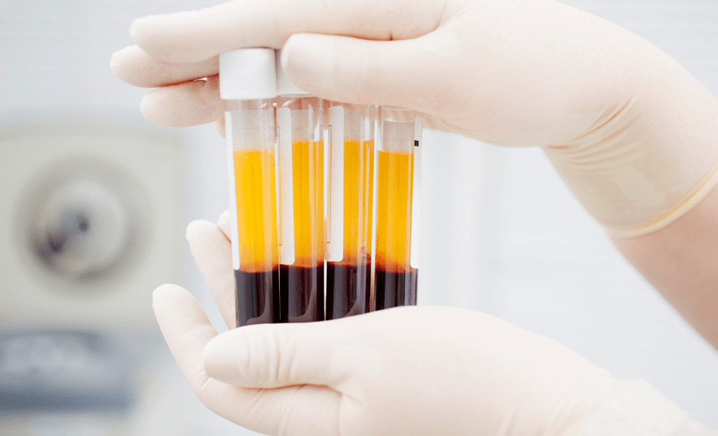 Vérlemezkében gazdag plazma arthrosis PRP terápiájához